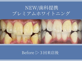 ホワイトニングカフェ 平塚店(WhiteningCafe)/◎歯のホワイトニング施術写真◎
