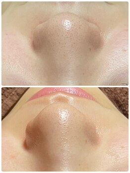 トータルビューティーサロン ヴィヴィエ(ViVier)/毛穴ケア症例　1回