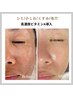 人気No1【毛穴/くすみ/しみケア】肌質改善ENVIRON高濃度ビタミン導入¥6500