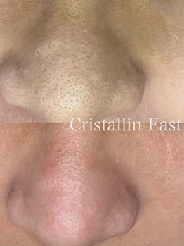 クリスタランイースト(Cristallin East)の写真/お肌の状態を見極めたピーリングでお悩みも解決♪看護師が手掛けるサロンで肌育！美肌へ　AI肌診断機で証明