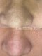 クリスタランイースト(Cristallin East)の写真/お肌の状態を見極めたピーリングでお悩みも解決♪看護師が手掛けるサロンで肌育！美肌へ　AI肌診断機で証明