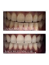 佐賀ホワイトニングラボ/印象が変わります