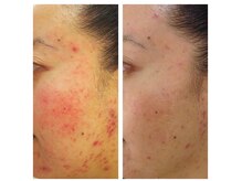 ハイケア グラン ギンザ(HYCARE GRAND GINZA)/日本ーの肌改善サロン実力/銀座