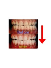 グロッシー(glossy)/セルフホワイトニング