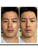 アン 銀座(ann)/レモンボトル