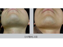 パルファム/結果重視のひげ脱毛