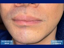 父さん専用ヒゲ脱毛の店/脱毛比較　＃ヒゲ脱毛＃脱毛