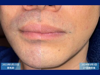 父さん専用ヒゲ脱毛の店/脱毛比較　＃ヒゲ脱毛＃脱毛