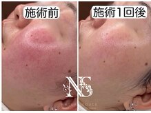 ナチュラ ソース(NatureSouce)の雰囲気（夏の紫外線による蓄積ダメージの鎮静ケア◎（毛穴洗浄））