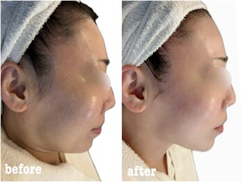 サロンドール(Salon doll)/洗浄×小顔リフト×カーボキシー