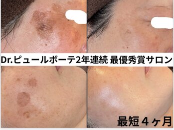 リアリア(LEALEA)/シミプログラム