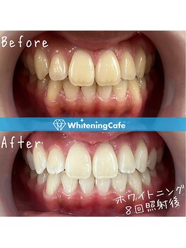 ホワイトニングカフェ 池袋東口店/ホワイトニングビフォーアフター