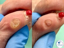 プラスワンフット 本厚木(+1 Foot)/タコ・魚の目ケア！痛みから解放