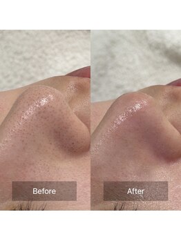 モトカ 横浜店(Motoka)の写真/【究極の毛穴ケア】たるみ毛穴~黒ずみまで徹底改善。韓国式毛穴洗浄+EMS導入で汚れスッキリ&リフトアップ◎