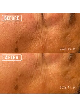 もみかる 静岡本店/二回でこの効果☆