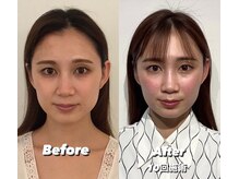 コルミチョン サロン(骨美整 salon)/Before・After 10回施術