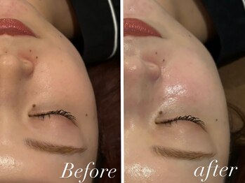 ビアス(Biasu)/水光肌☆バクチオールピール