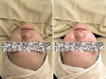 マヴィ 高槻店(MavY.)/ニキビケア肌荒れに