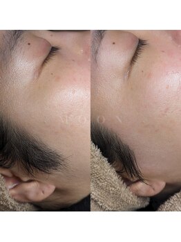 ムーン 横浜(MOON)/【もみあげ・眉周り】