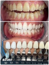 エクシアホワイトニング 札幌中島公園店/Before After［ホワイトニング］