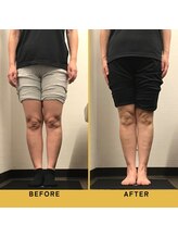 ベル/【50代会員様】O脚矯正の変化