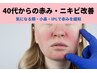 思い当たりませんか？肌の赤み・ニキビ改善はIPLの光ケア