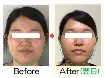 小顔矯正エステ プリュムレーヴ/30代｜丸顔引き締め小顔