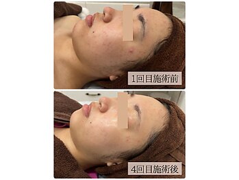 リノン(LINON)/韓国ピーリング 施術回数4回