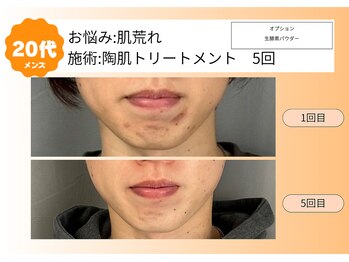 ムーンサン(Moon sun)/20代メンズ　肌荒れ