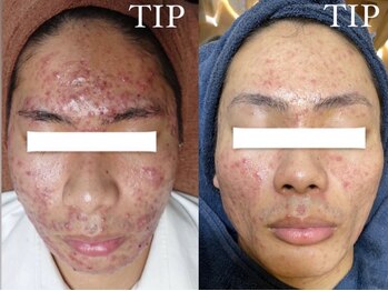 アリス(ALICE)/ニキビ改善はハーブピーリング