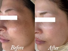 ローズルート(Rose route)/30代後半ママさん　6回施術