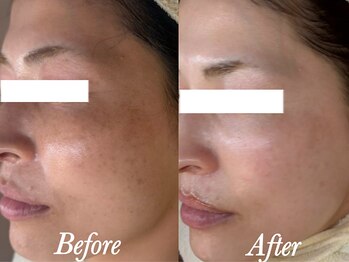 ローズルート(Rose route)/30代後半ママさん　6回施術