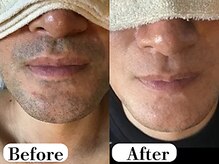 ビースキン 広島(BE:SKIN)/髭/全身脱毛/フェイシャル/VIO