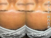 ダリア(Dahlia)/おでこの詰まり感のお悩みに