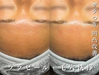 ダリア(Dahlia)/おでこの詰まり感のお悩みに