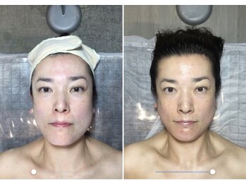 自然美人/小顔コルギの効果