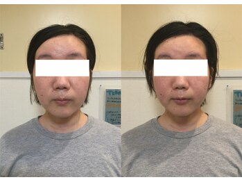 プリンセス バイ セイフティプリンセス 長野店(PRINCESS)/《ソフトタッチの》小顔矯正♪