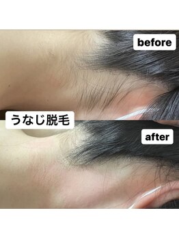 ミノア 熊本店(MINOA)/うなじ脱毛◆ビフォーアフター