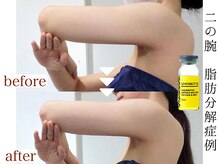 カピリナスパ(Ka.Pilina Spa)/レモンボトル　二の腕コース