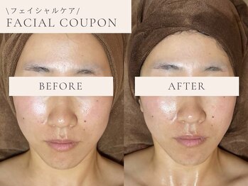 フォルトゥナ(Fortuna)の写真/【土台を整え即小顔♪圧倒的持続力】首肩・デコルテから引き上げる最新機器NR波◎むくみ・たるみを根本改善