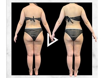 エステティック エイチアンドビー 大和店(H&B)/ビフォーアフター