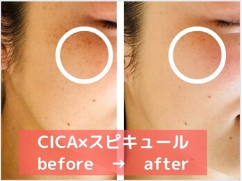 エスプリクレール(Esprit Clair)/マイクロニードルジェルピール