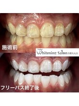 ホワイトニングサロン 京都烏丸店/ホワイトニング施術例