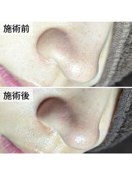 美鼻ラボ 押上 曳舟/黒ずみ・詰まり両方に!