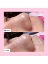 ホワイトラボ 新潟万代(White labo)/【施術例】ハイドロフェイシャル