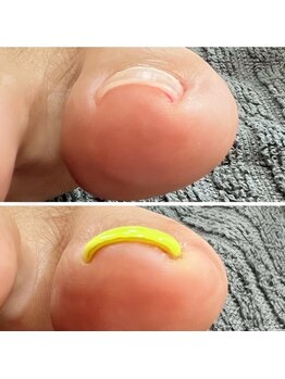 巻き爪/フットネイル/ワンカラー