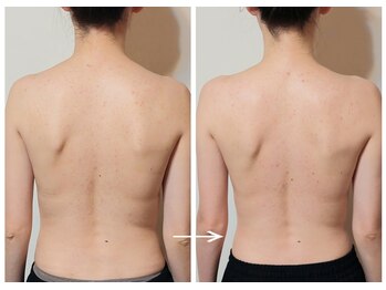 ラグーン(LAGOON)/ロミロミ2週間後の施術後変化