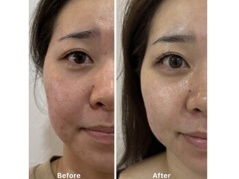 ベル(Belle)/ウエディング前フェイシャル