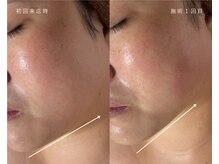 サバーイ サバーイ(SABAHI SABAHI)/【たるみ改善】半永久小顔形成