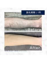 メンズクリア 高知帯屋町店/【メンズクリア】お客様の施術例